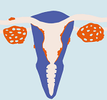 子宮内膜症-病気・症状と治療