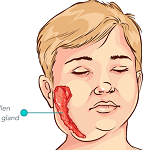 流行性耳下腺炎(おたふくかぜ)-病気・症状と治療
