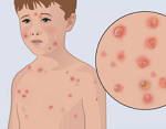 水痘・帯状疱疹-病気・症状と治療