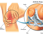 膝関節痛-病気・症状と治療