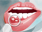 口内炎-病気・症状と治療