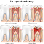 歯痛-病気・症状と治療